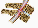 stenosis